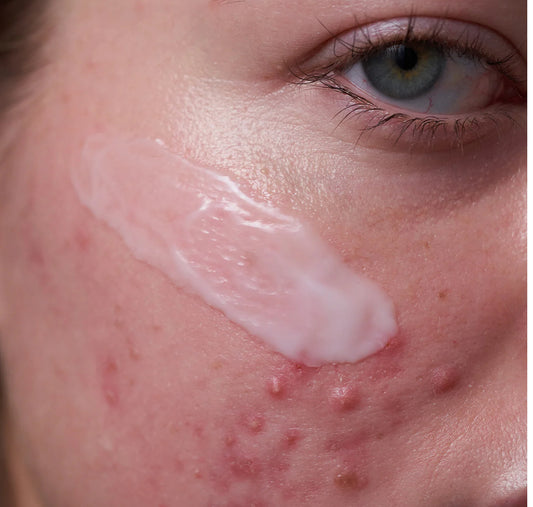 Anti Acne Duo-Eco friendly & Sustainabl